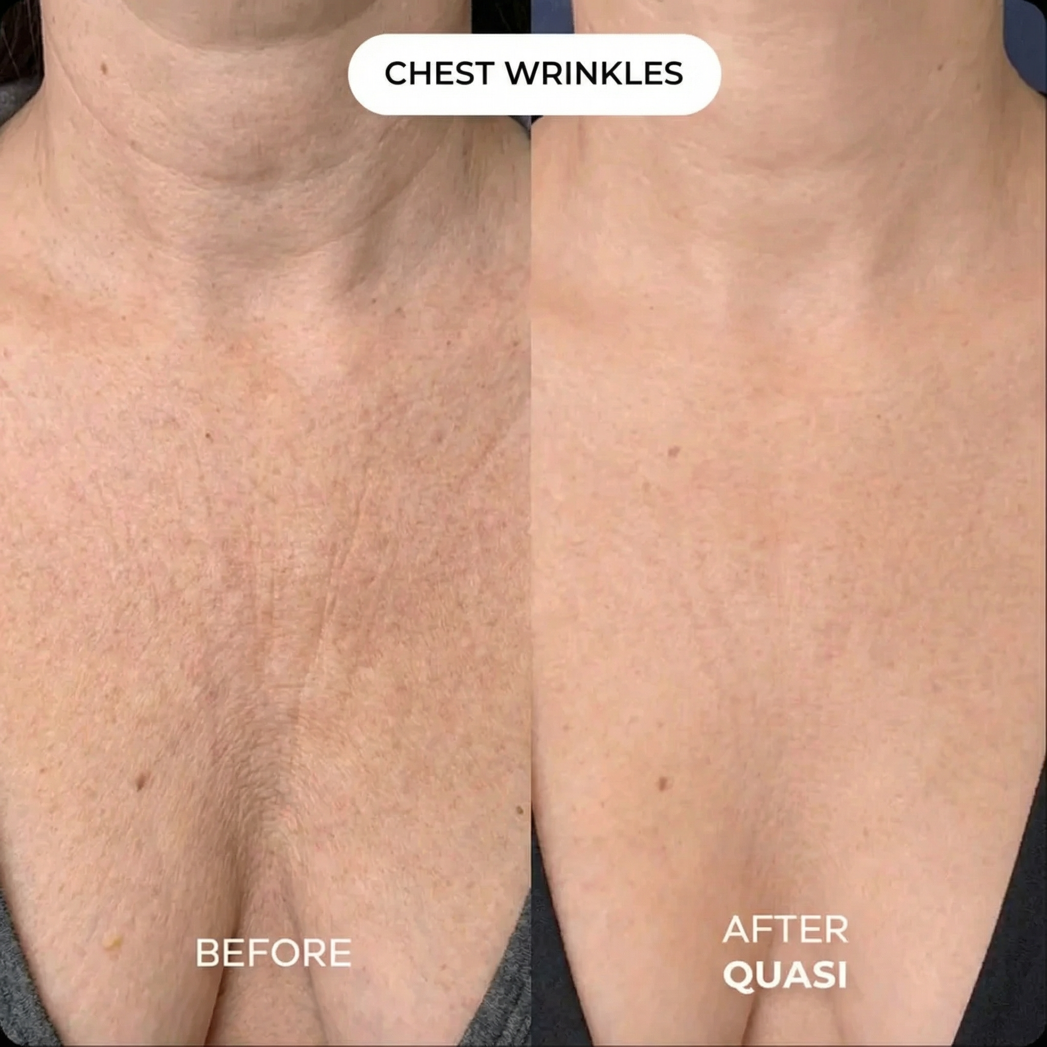 Collagen Chest Mask (free gift)
